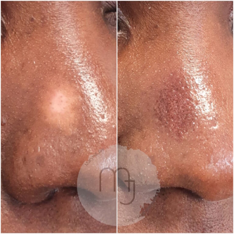 Camouflage_taches_vitiligo