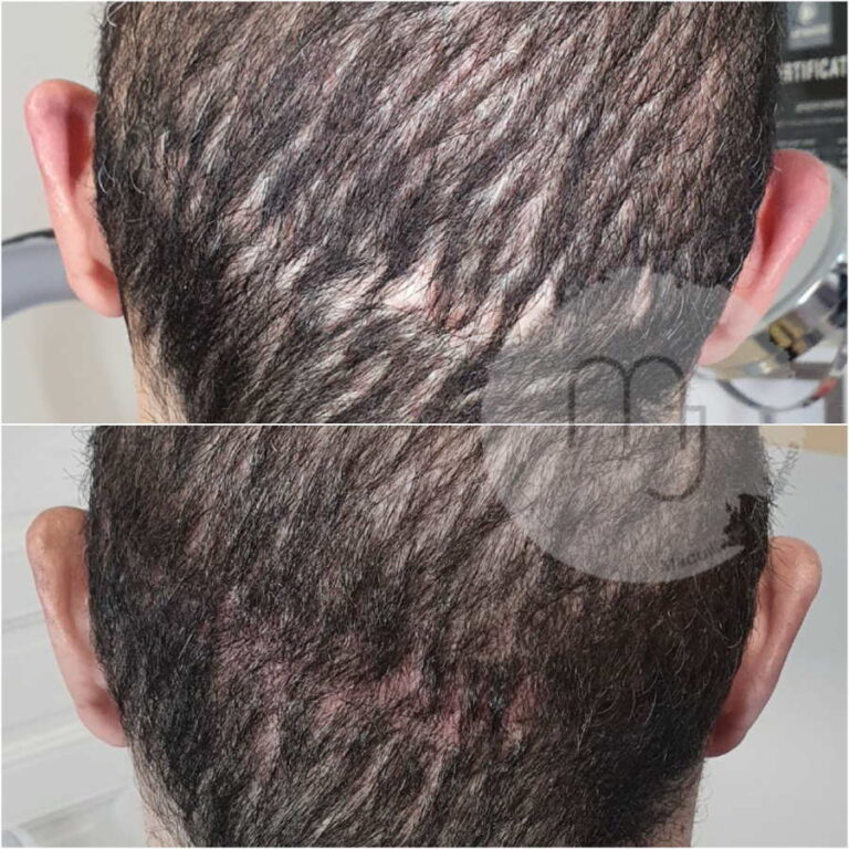 Camouflage-cicatrice-tête-homme-2