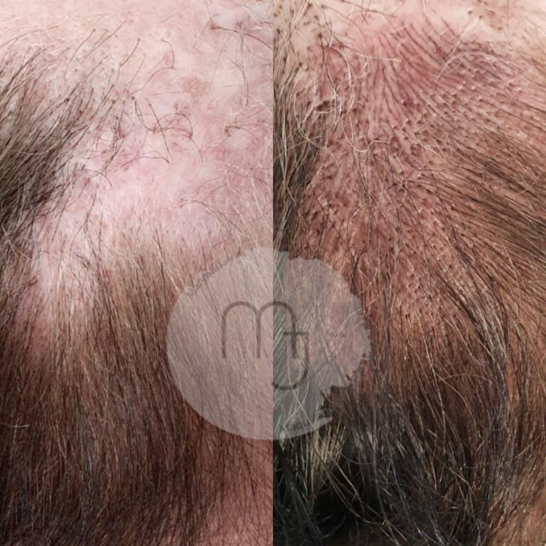 PIgmentationCuirChevelu01
