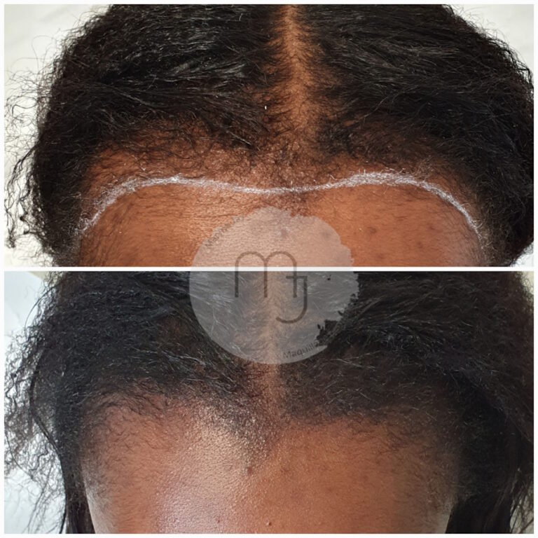 Pigmentation-cuir-chevelu-femme