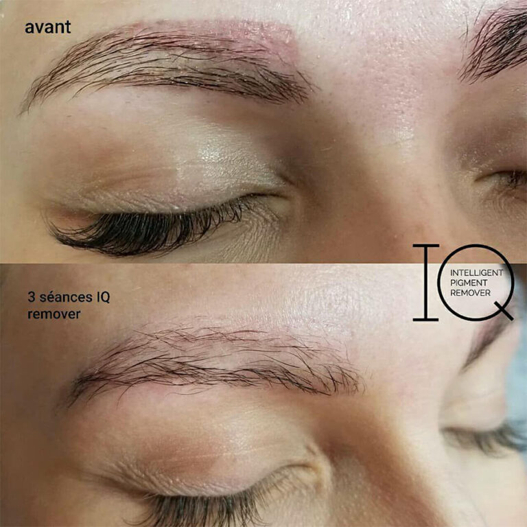 détatouage-sourcils