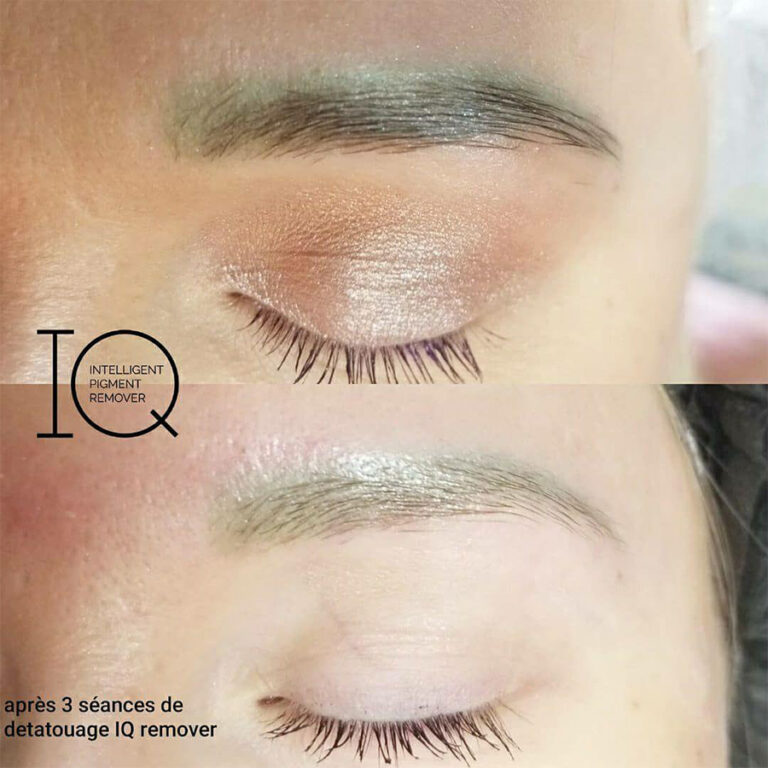 détatouage-sourcils-2