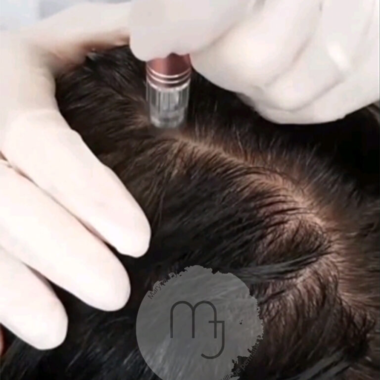 microneedlingcuirchevelu03