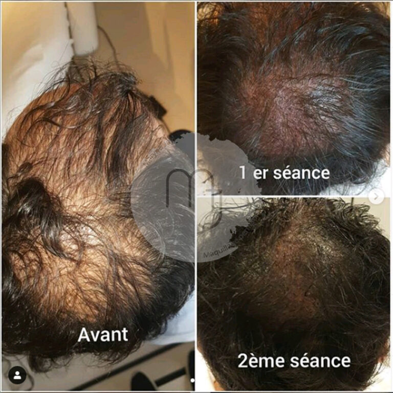 trichopigmentation01