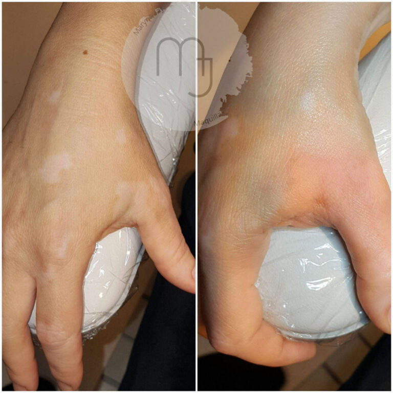 Camouflage-vitiligo-main