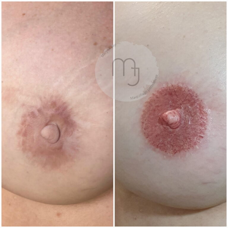 Aréole_unilatérale