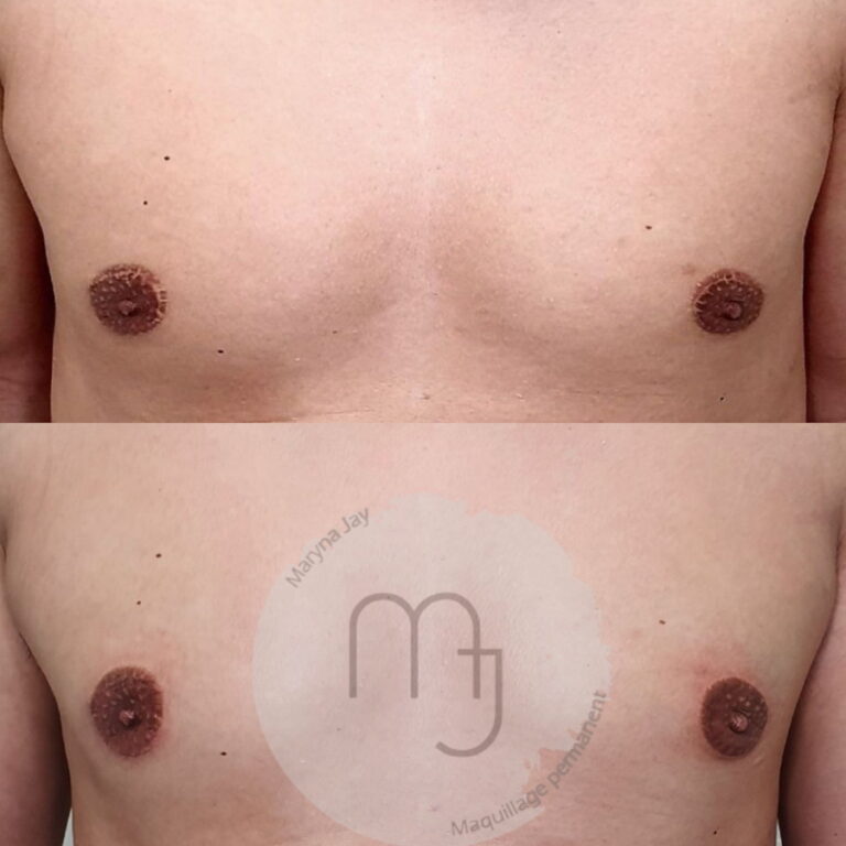 Camouflage-cicatrices-aréoles-homme