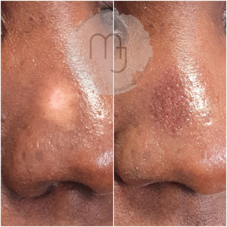 Camouflage-vitiligo-nez