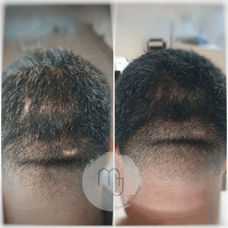 Camouflage-cicatrices-cuir-chevelu-Homme