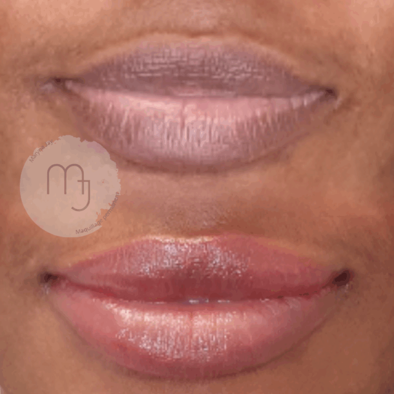 correction-asymetrie-lèvres-foncées