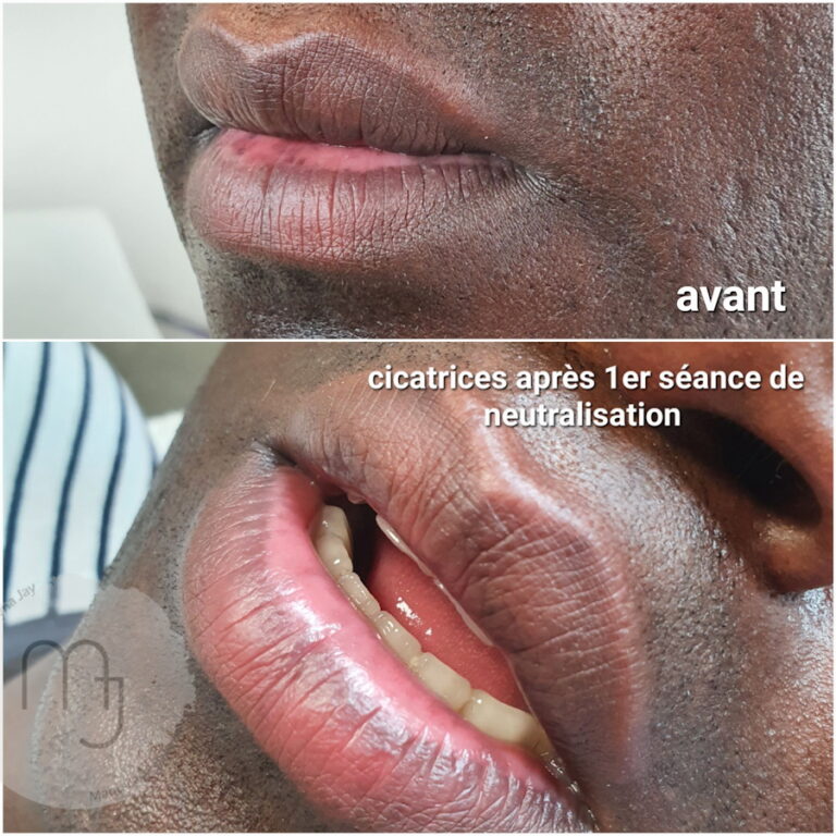 Neutralisation-lèvres-foncées-homme