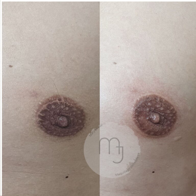 aréoles_unilatérale_homme