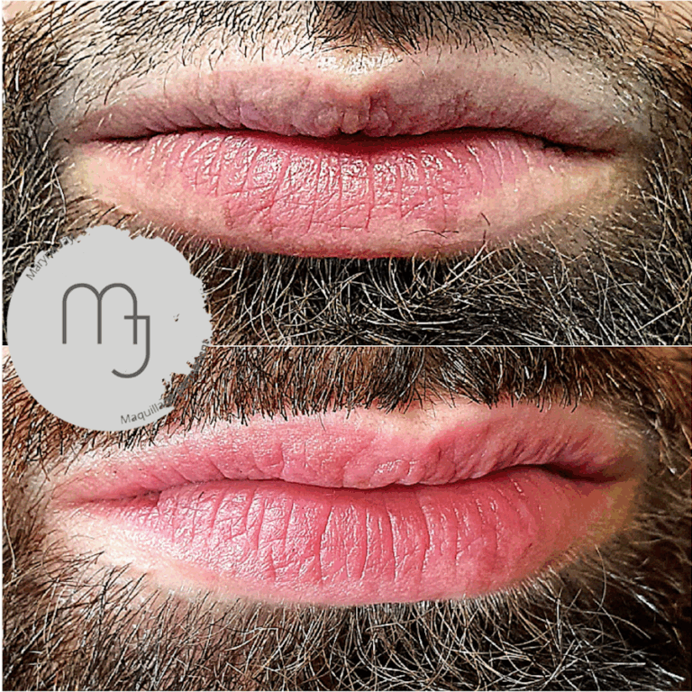 Camouflage-brûlures-Lèvres-homme