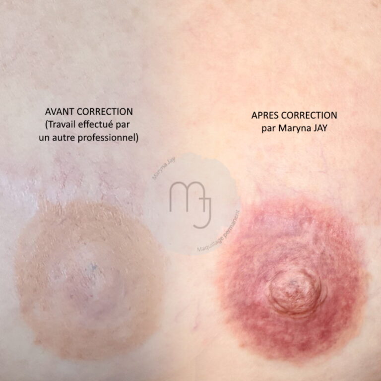 Correction Aréoles 3D