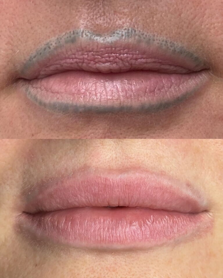 Détatouage des lèvres sans laser avant après à Paris par Maryna Jay