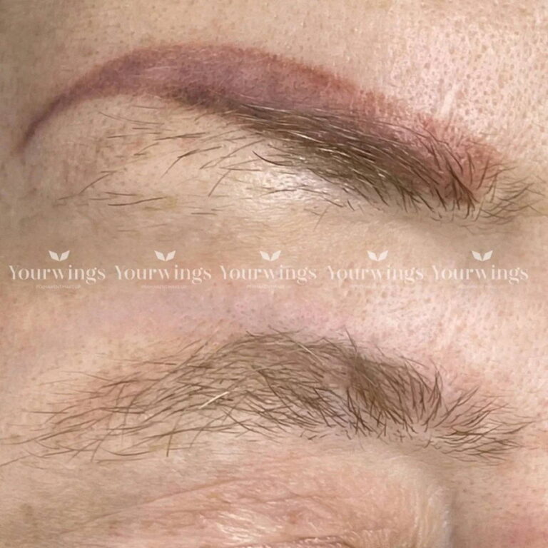 Correction de sourcils orangés par détatouage sans laser à Paris