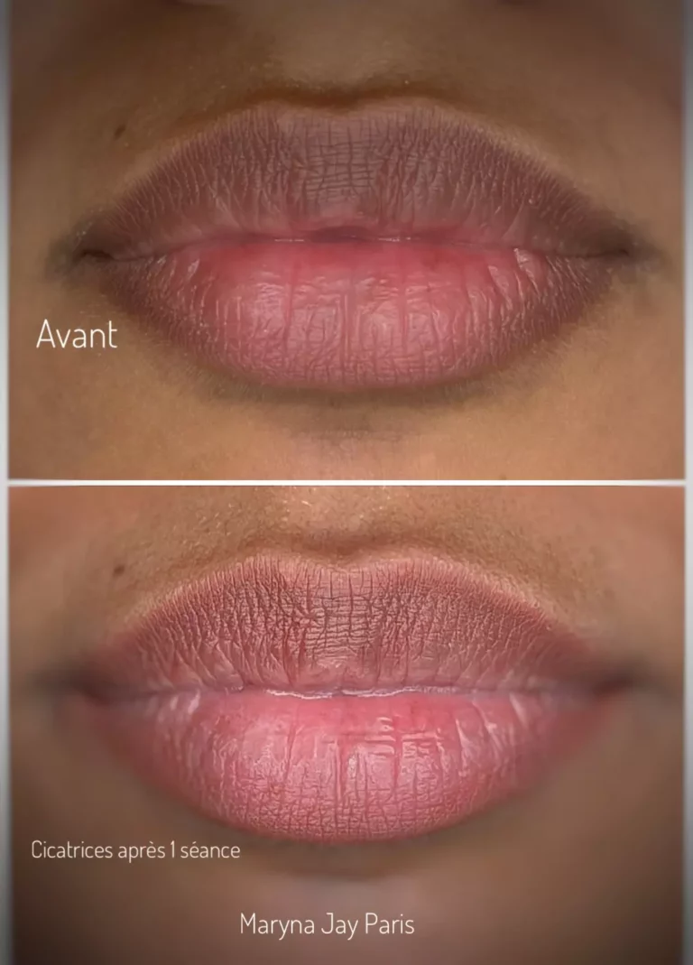 Avant et résultat cicatrisé après une séance Dark Lips Balance® sur lèvres foncées par Maryna Jay à Paris