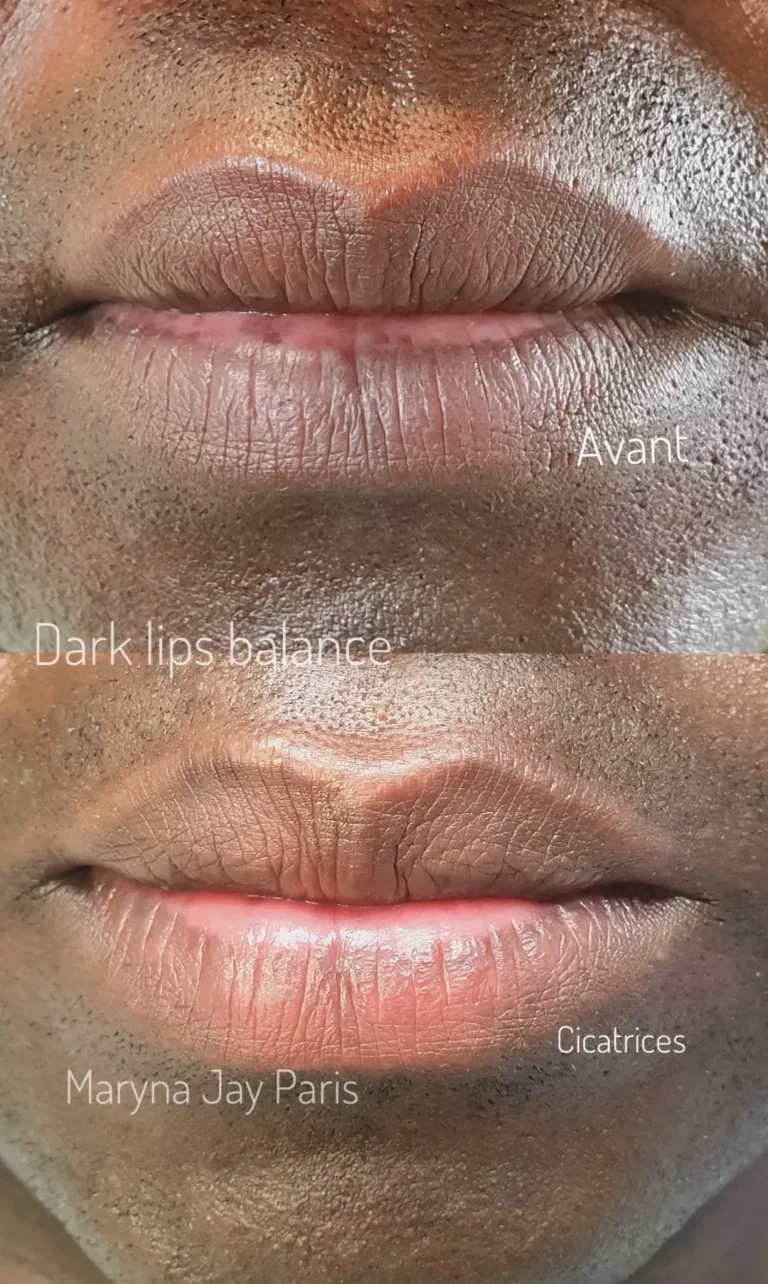 Avant après éclaircissement visuel de lèvres foncées chez un homme avec Dark Lips Balance® par Maryna Jay à Paris