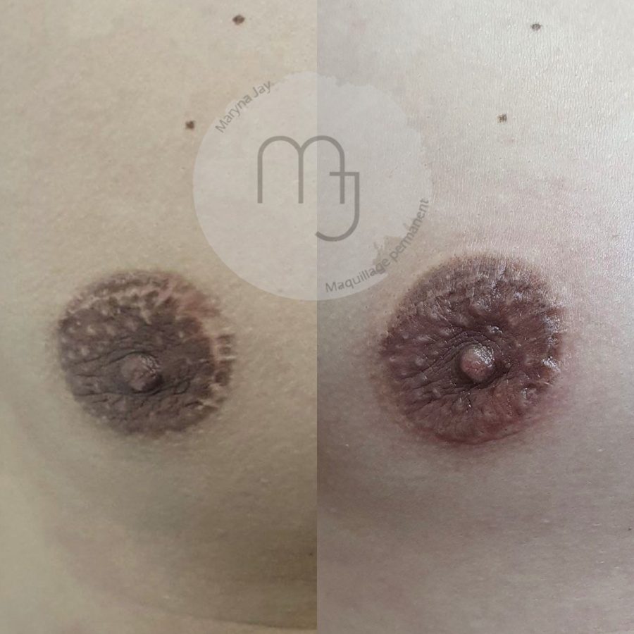 Camouflage-cicatrice-aréole-homme