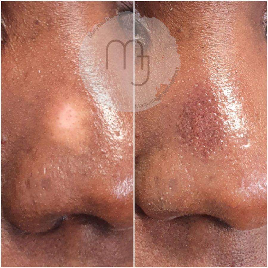 Camouflage-vitiligo-nez