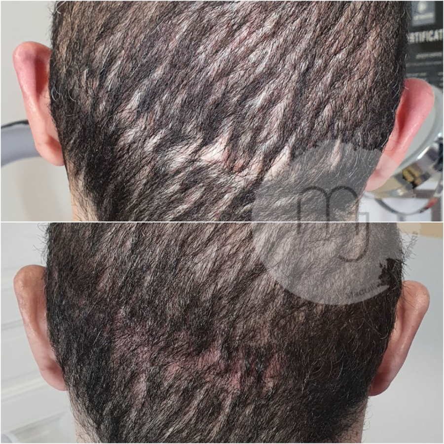 Camouflage-cicatrice-tête-homme-2