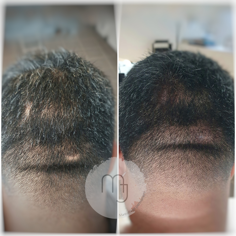 Camouflage-cicatrices-cuir-chevelu-Homme