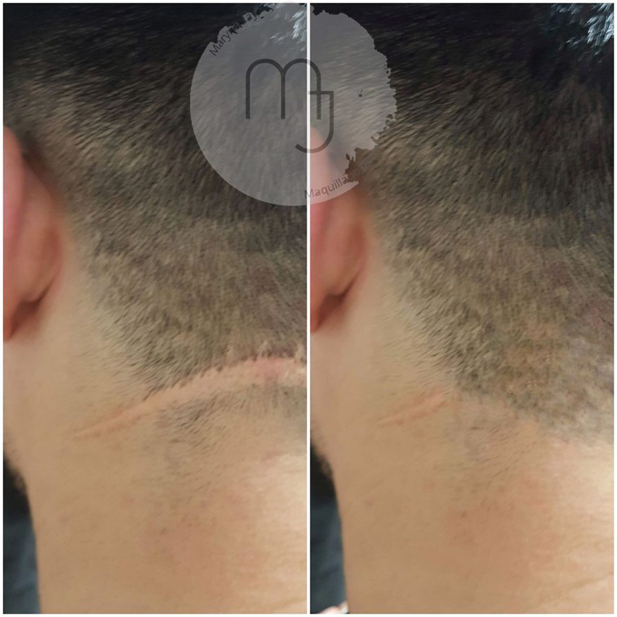 Camouflage-cicatrice-tête-homme